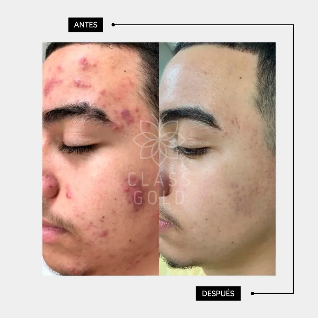 Mascarilla Soft face 
