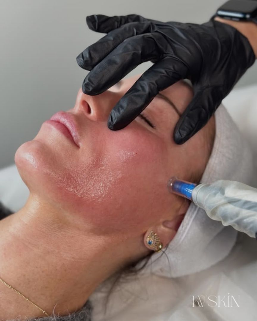 Microneedling 
