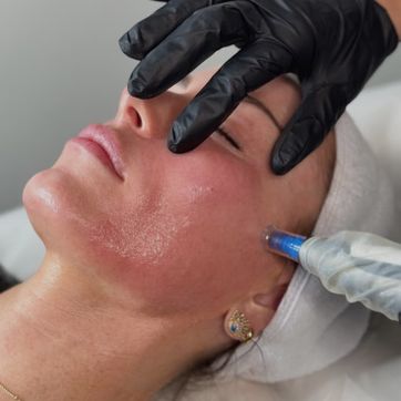 Imagen del producto Microneedling 