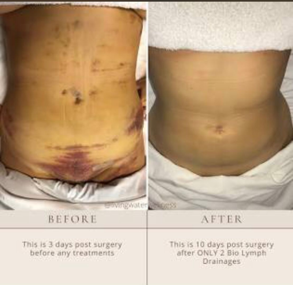 Tratamiento y masages post operatorio y fibrosis 