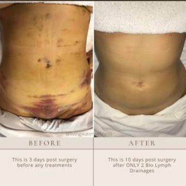 Imagen del producto Tratamiento y masages post operatorio y fibrosis 