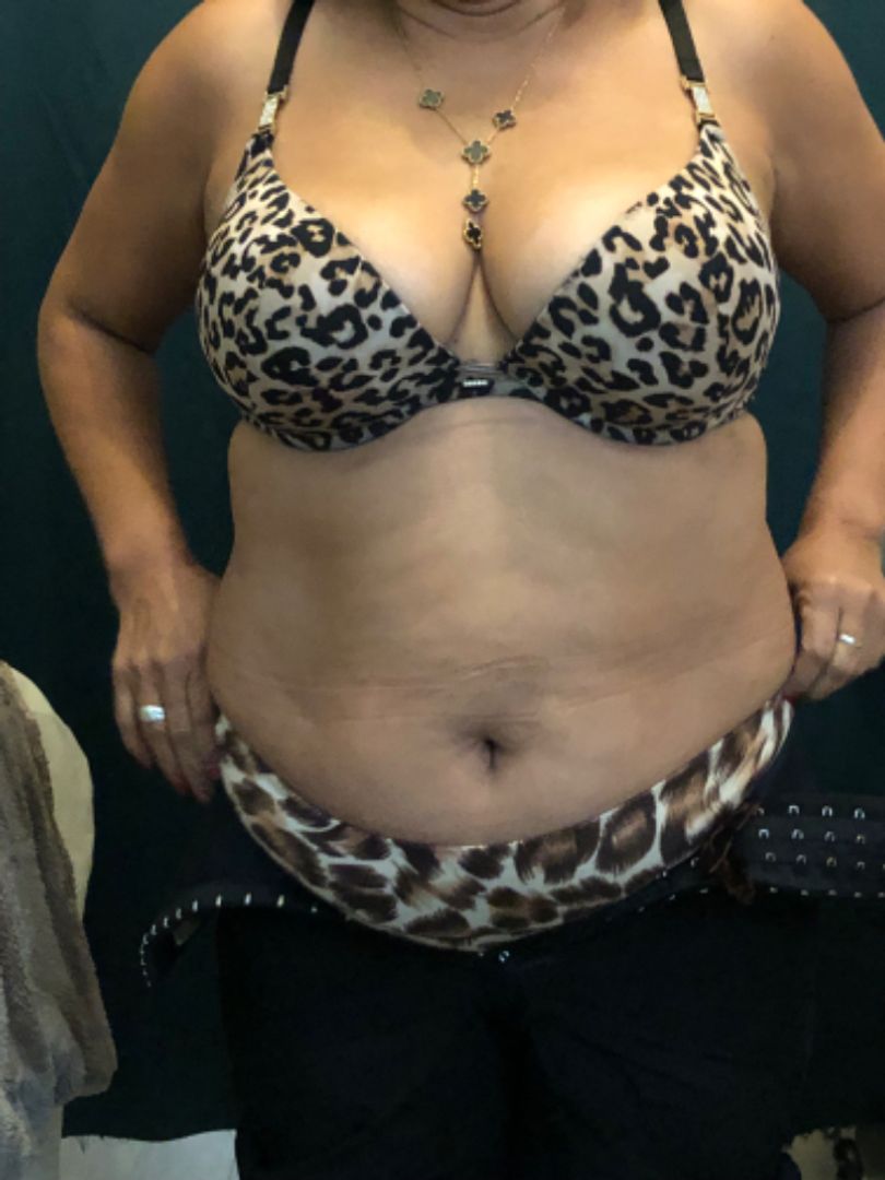 Faja de compresión abdomen bajo y alto color negra . Tiras ancha , broches acero, levanta cola 
