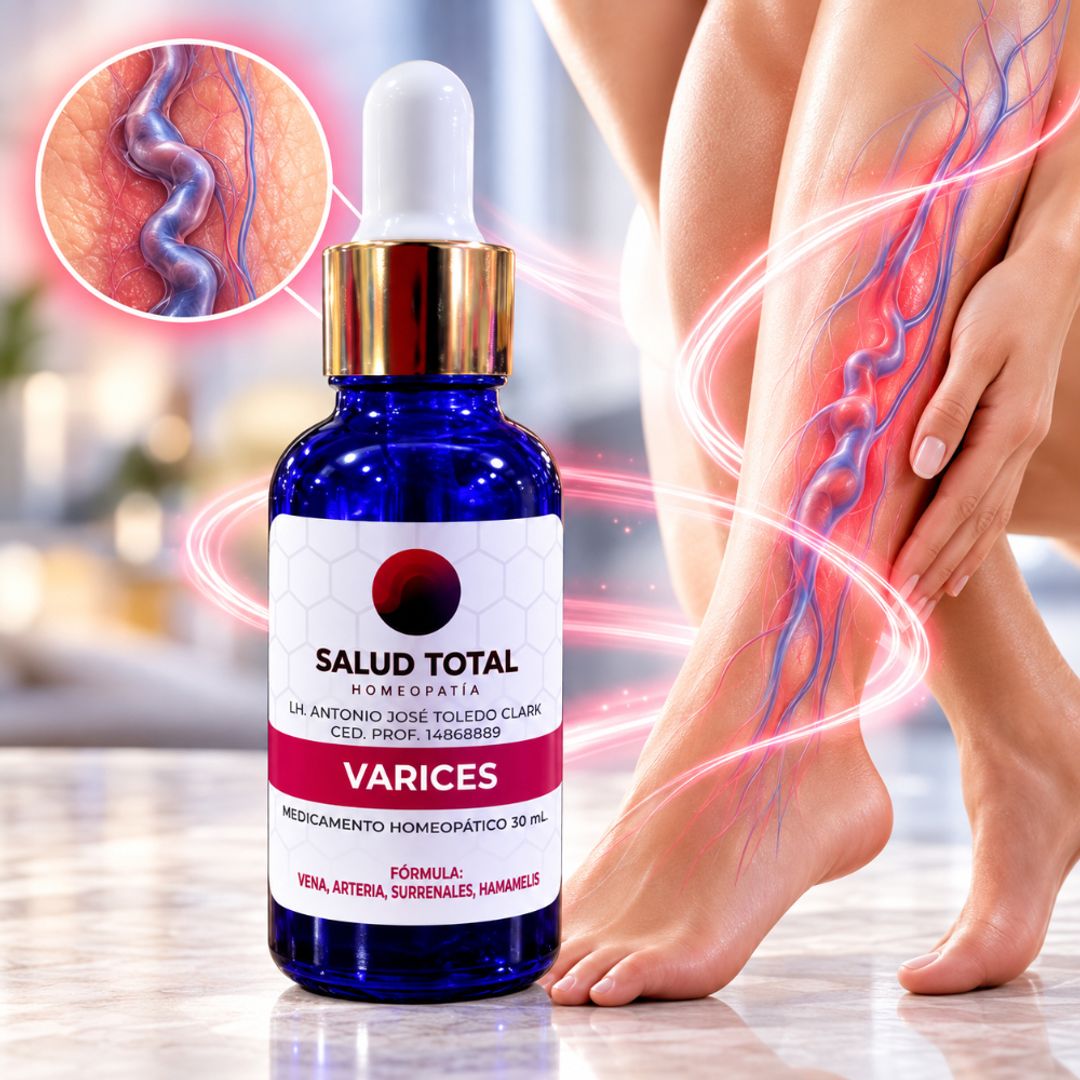 Varices