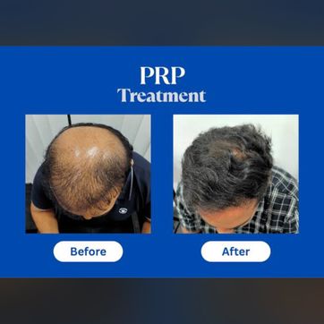 Imagen del producto Prp capilar 