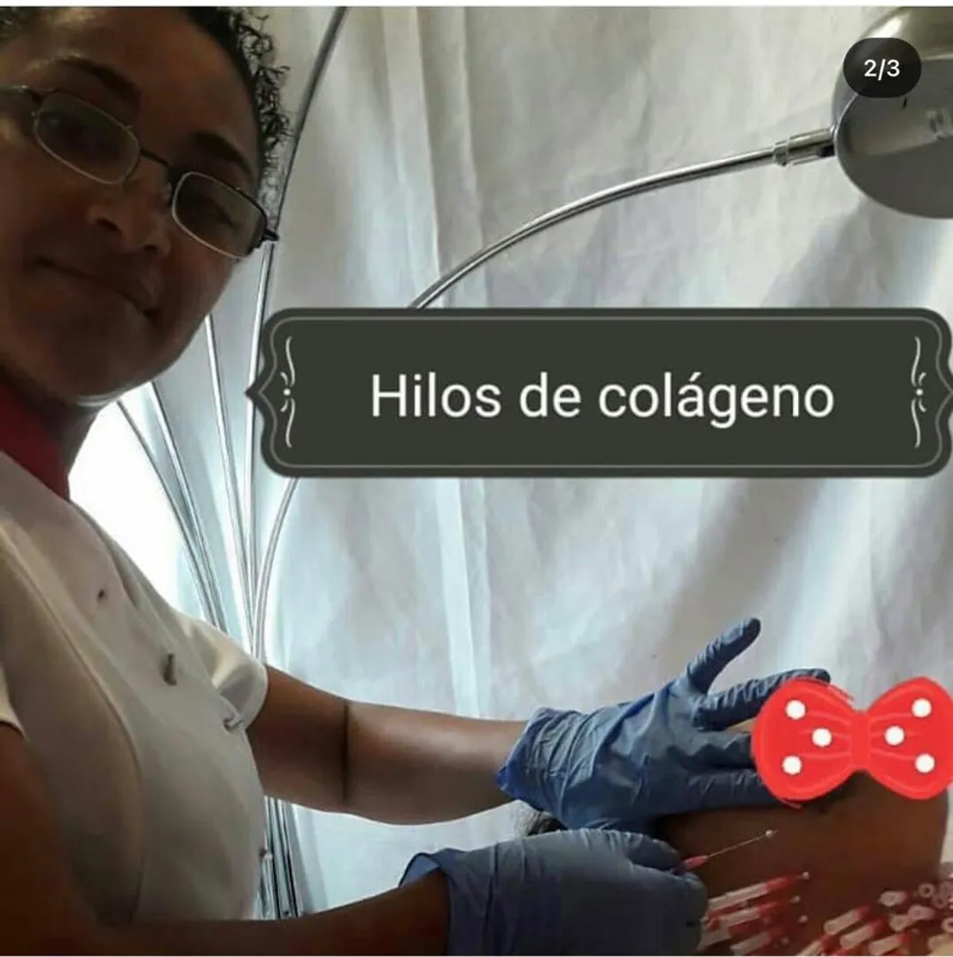 Hilos de colágeno estimulación 