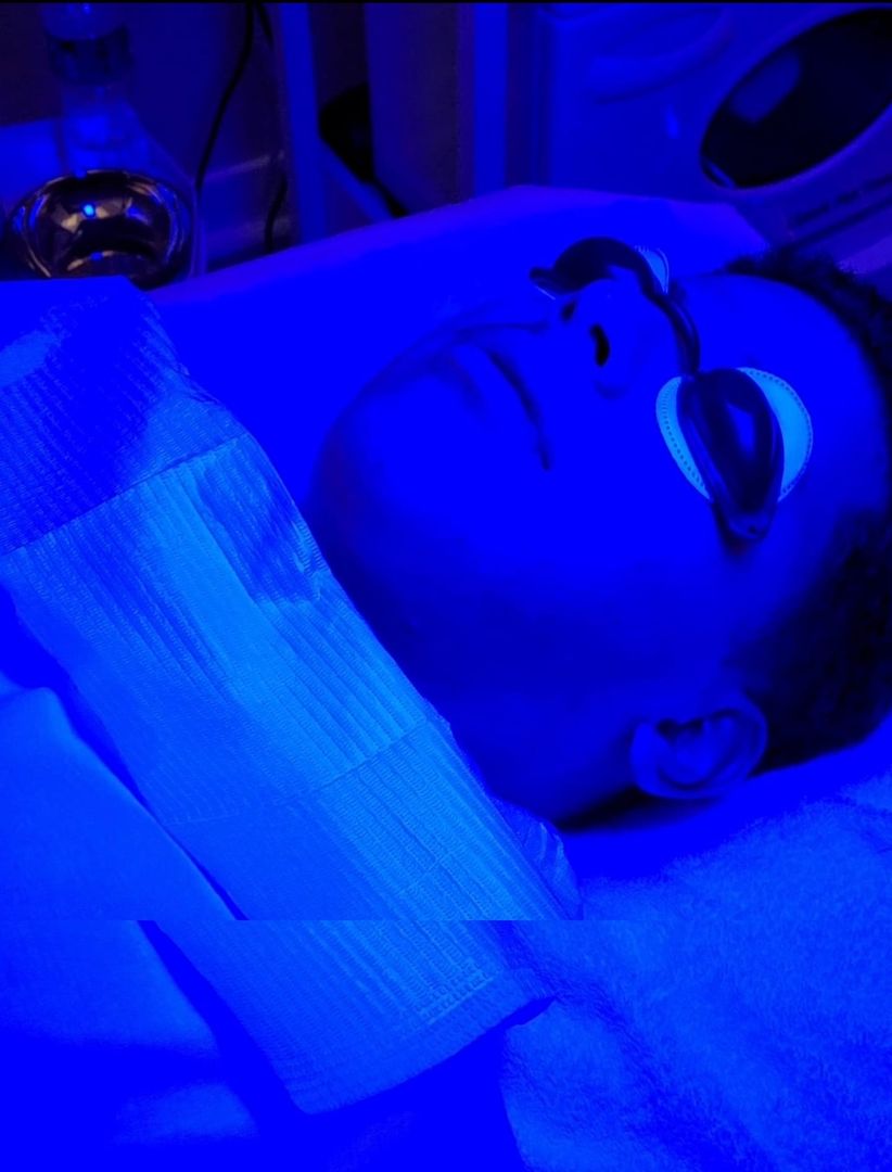 Limpieza Para El Acne 