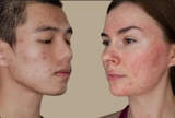 Imagen de la categoría ACNE
